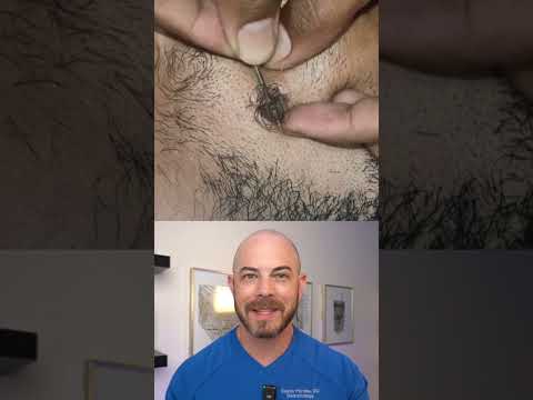 Derm reacts to INSANELY hairy extraction! #dermreacts #doctorreacts #extraction