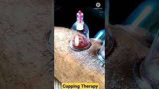 Cupping Therapy #short#रक्तमोक्षण#ayurveda screenshot 5