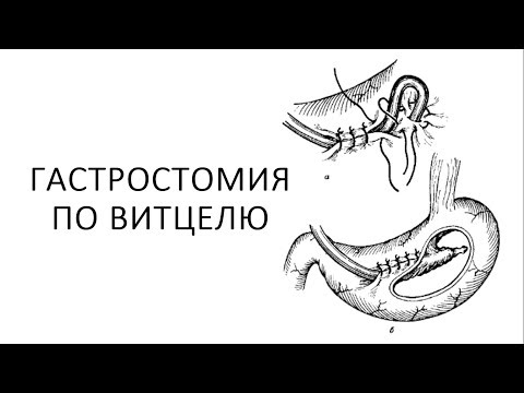 Гастростомия по Витцелю. Оперативная хирургия.