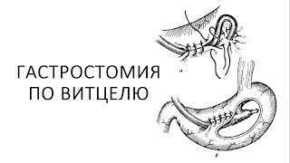 Гастростомия по Витцелю. Оперативная хирургия.