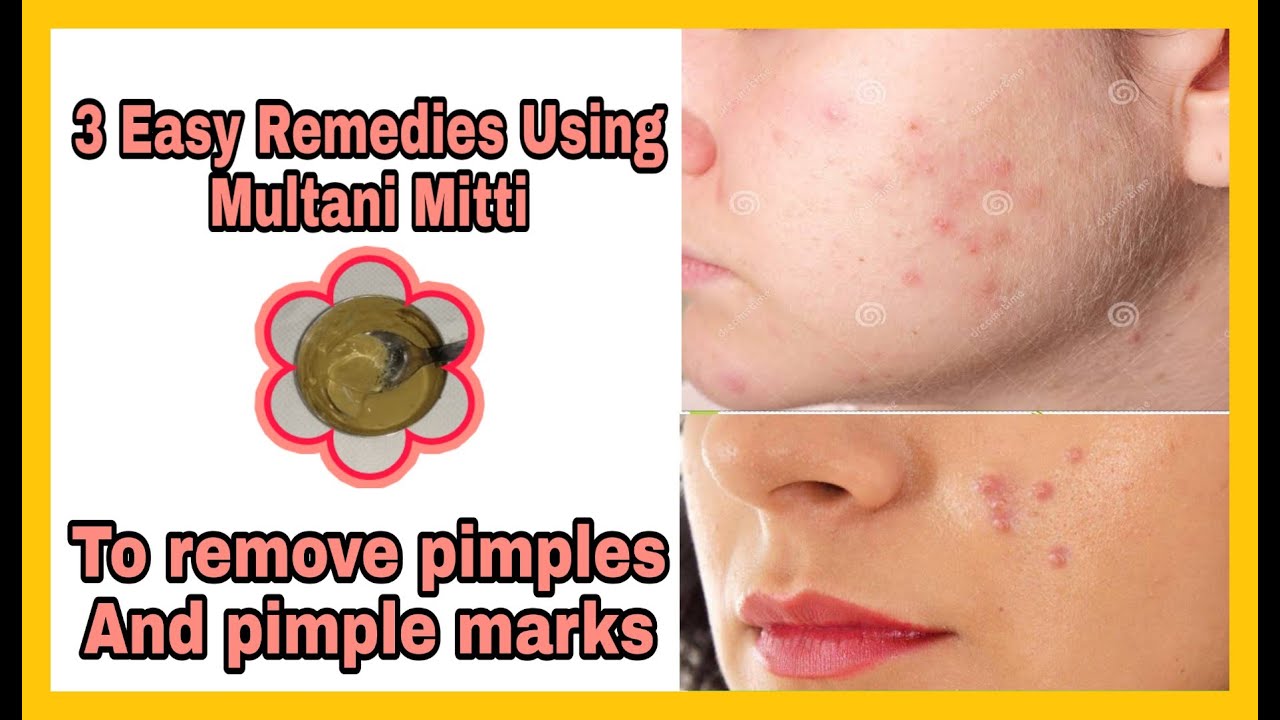 does multani mitti remove acne