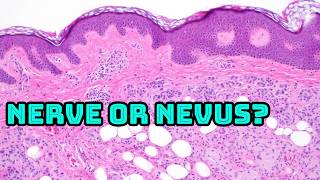 Neurotized Nevus: When a Mole Looks Like Nerve
