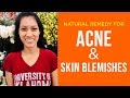 Acne  pimples  tigyawat  other skin blemishes  dr farrah healthy tips