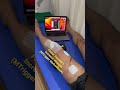 Acl surgery exercise /static quads activation /quadriceps Exercise #physiotherapy #aclrehab #shorts