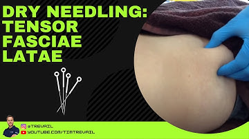 Dry Needling: Tensor Fascia Latae
