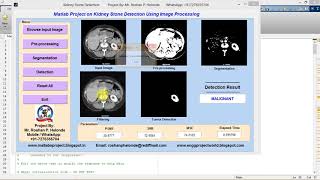 Kidney Stone Detection Using Matlab Project Code