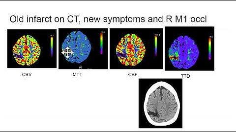 Video 3 of 3:  How to Interpret a Brain CT Perfusion Scan for acute stroke