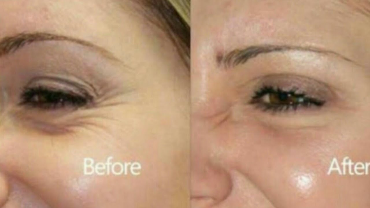 How to get rid of Under Eye WRINKLES with 2 handly Ingredient plain and ...