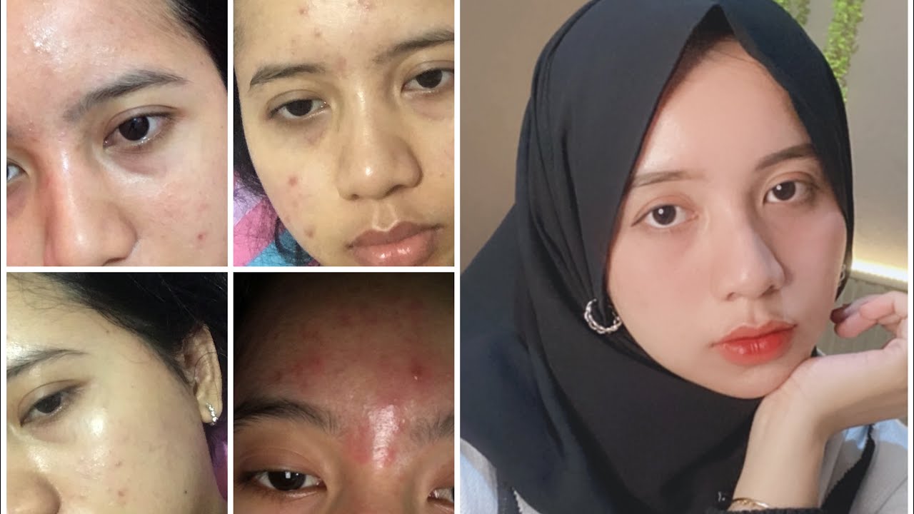 Pengalaman sembuh dari jerawat My Skinjourney | My Acne Story 