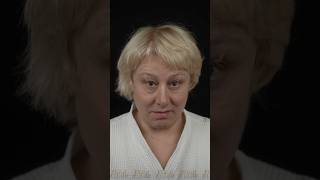 Трансформация взгляда. Круговая блефаропластика. Доктор ПЕРМЯКОВ