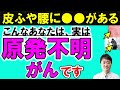 【放置禁止】原発不明がんの意外な７つの初期症状　森永卓郎さんは本当にすい臓がんでなく原発不明がん？　どんながんかを専門医が解説