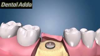 Dental Implant Animation video