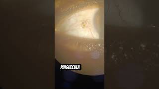 pinguecula ka bachav #pinguecula #eyeclinic eye health #optometrist #optometrylife #healthy