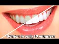 How to whiten your teeth at home for cheap (100% works guaranteed)