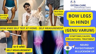 BOW LEGS in Hindi | Genu Varum | Precautions, Symptoms, Self Test, Treatment | तिरछे घुटने का इलाज