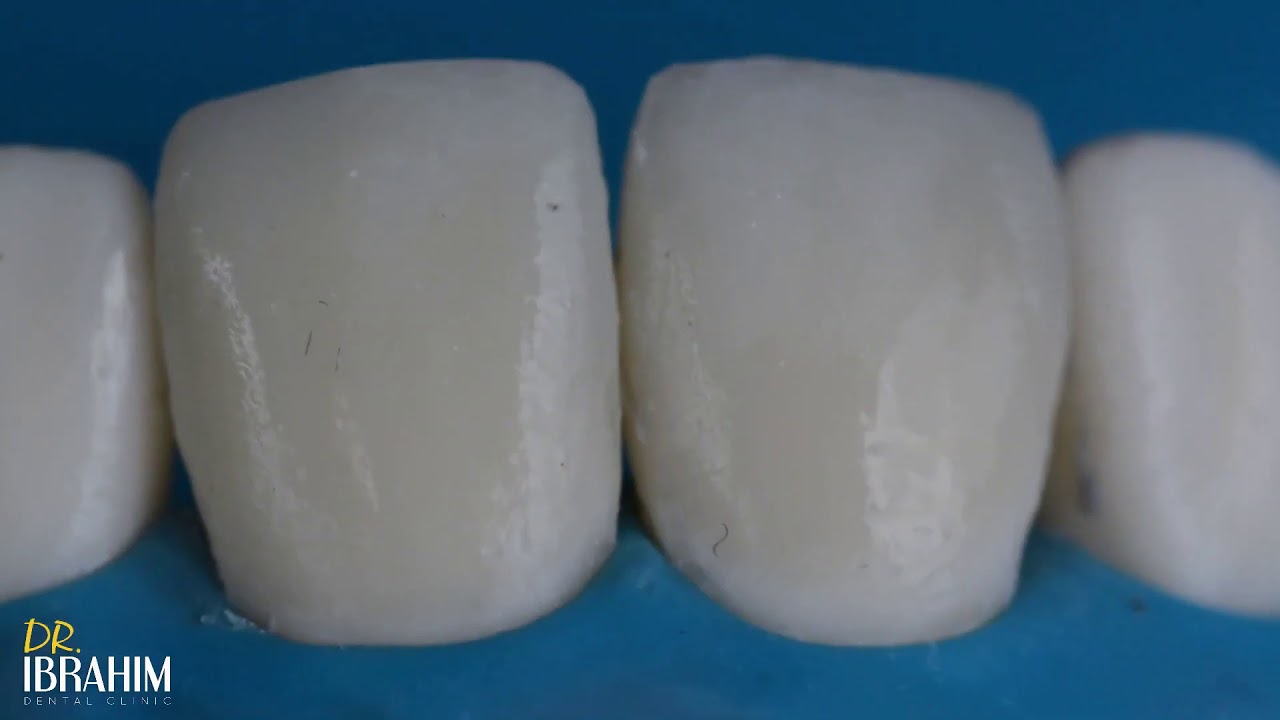 Direct Composite Veneer  Finishing & Polishing Protocol " DR :Ibrahim Abdelmunim "