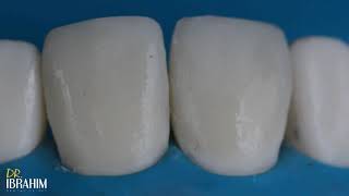 Direct Composite Veneer  Finishing & Polishing Protocol  DR :Ibrahim Abdelmunim 