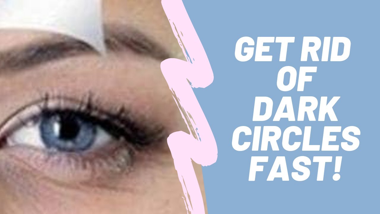 How to Treat Dark Circles Under Eyes In Just 5 Days! [Must Watch] YouTube
