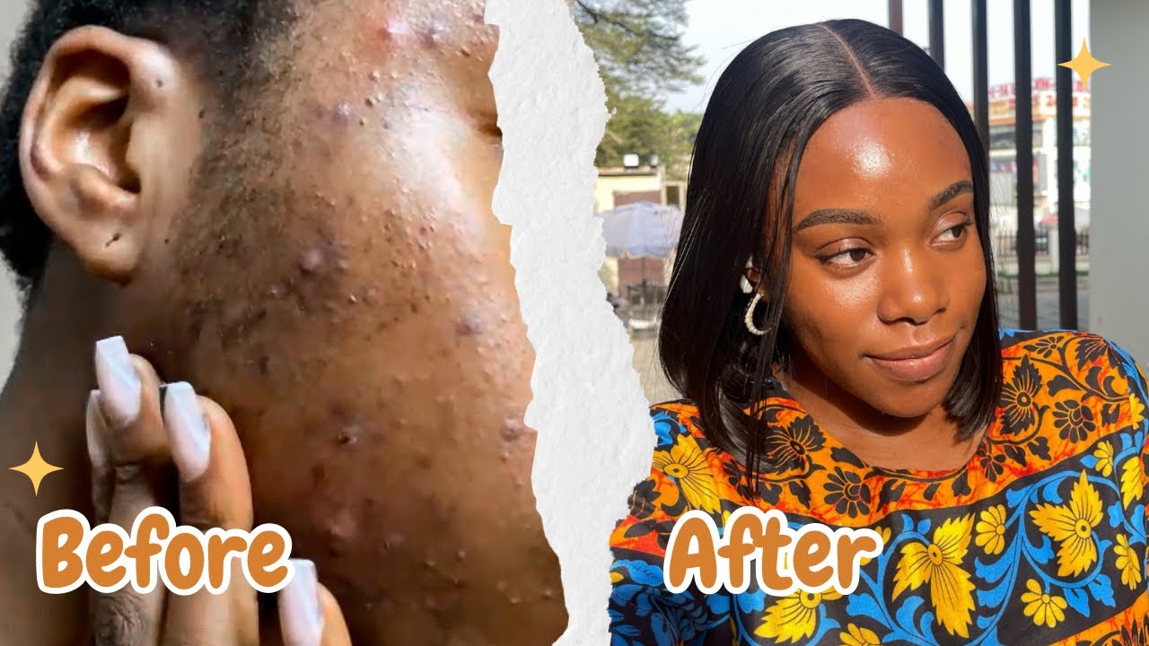 How I CLEARED MY ACNE | 3 Products that WORKED WONDERS | morning ...
