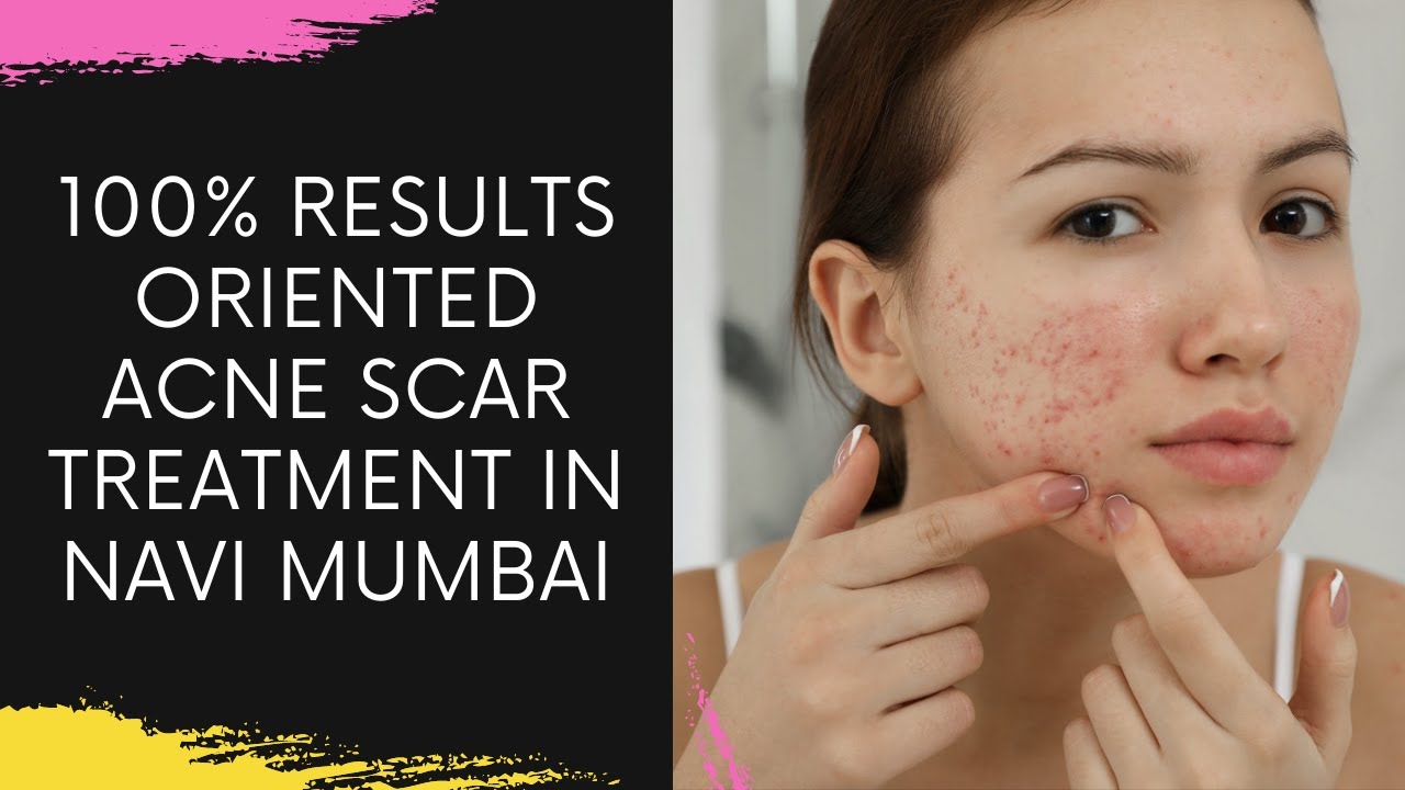 Acne Scar Removal Treatment in Navi Mumbai The Cost Of Acne Scar