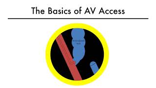 Hemodialysis Access 101 01  The Basics of AV Access