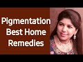 How to remove Pigmentation /Brown spots /Freckles /Melasma Easy Home Remedies - Indu Ahuja