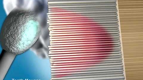 Tooth Mousse Video - White Spot Lesions