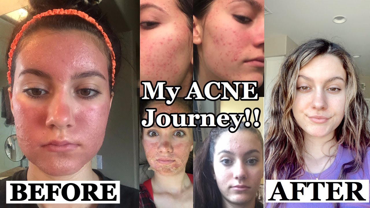 MY ACNE STORY! HOW I CLEARED MY SKIN! *With Picture's* - YouTube