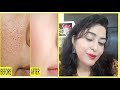 Get Rid of LARGE PORES in 3 Days  | Open Pores Treatment at home | खुले रोम छिद्रों को कैसे बंद करें