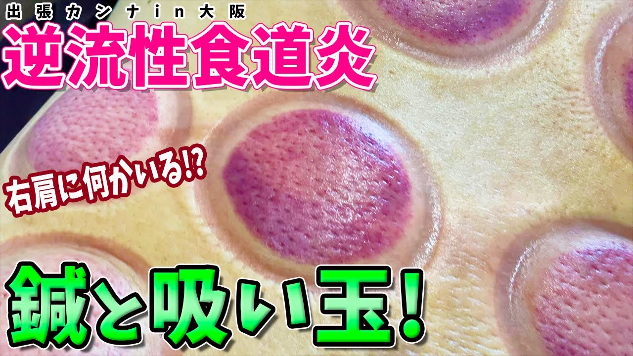 Cupping Therapy for Reflux Esophagitis] Dr. Makiel performs
