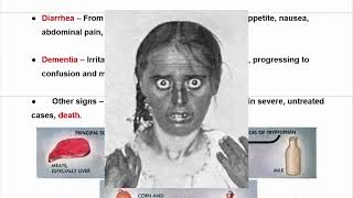Celebrity Vitamin B3 Deficiency (Pellagra) | Causes, Symptoms & Management Wealth