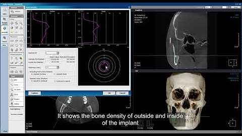 Xelis Dental Case Tutorial ImplantBone Density