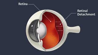 Sabril's 'vigabatrin' significant adverse effect.