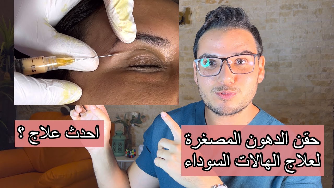 اخيرا بقي فيه علاج نهائي للهالات السوداء بالدهون المصغره( النانو فات ) ؟