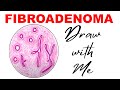 FIBROADENOMA- Illustration ! Draw with me