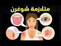جفاف العين والفم قد لا يكون أمر طبيعي متلازمة شوغرن التي يعاني منها كثير من الناس دون أن يعرفوها