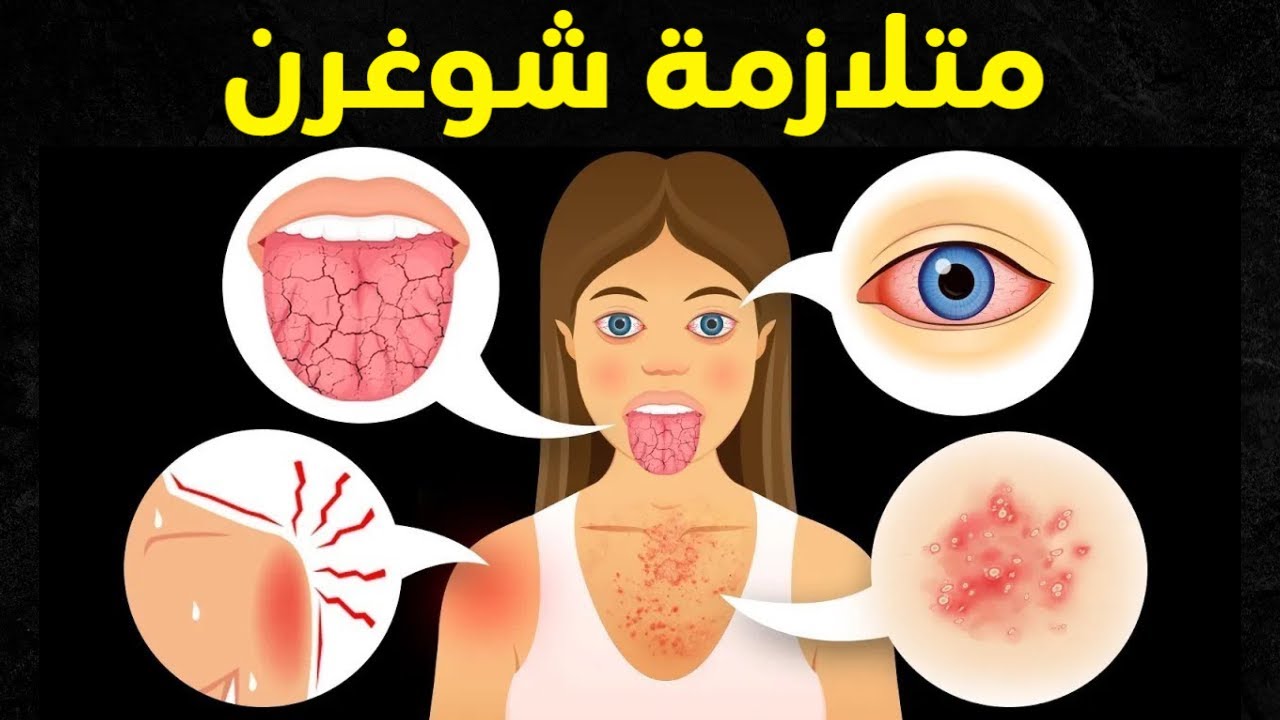 جفاف العين والفم قد لا يكون أمر طبيعي | متلازمة شوغرن التي يعاني منها كثير من الناس دون أن يعرفوها