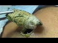 [ASMR] Sharp Ingrown Trimmed! Soothing Skincare Treatment | Relaxing Facial Wellness 0212m1 3617
