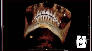 Dentists: CBCT review of sialolith
