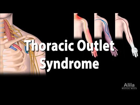 Thoracic Outlet Syndrome (TOS), animatie