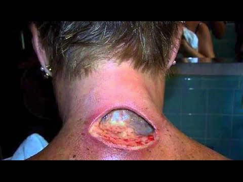 Koala Attack Safety Warning For German Backpackers