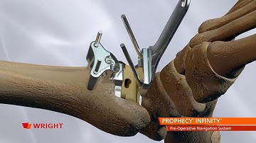INFINITY™ Total Ankle System featuring PROPHECY™ Preoperative Navigation