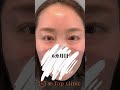 眼瞼下垂ダウンタイム経過#眼瞼下垂 #ダウンタイム #眼瞼下垂手術