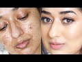 How To Cover Acne Scars Using Only Two Products | Simor Singh