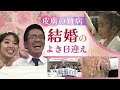 「理解してくれる人は、必ずいる」皮膚の難病“魚鱗癬”の青年　幸せの日を迎えて決意