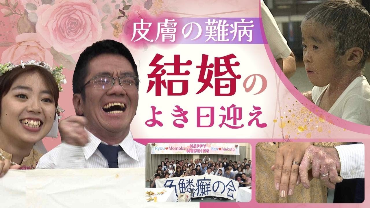 「理解してくれる人は、必ずいる」皮膚の難病“魚鱗癬”の青年　幸せの日を迎えて決意