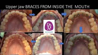 Braces from inside the mouth