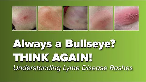 Think the Lyme Disease Rash is Always a Bull's-eye...