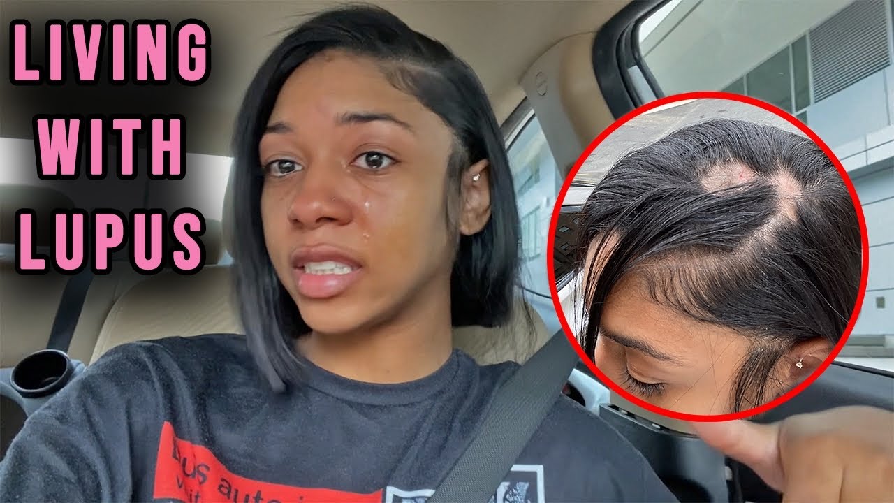 Living with Lupus: Finding out I have Lupus instead of Alopecia