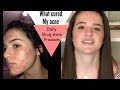 Clear up ACNE at home QUICK?  No Accutane!!!  clearer skin for Prom  No expensive products